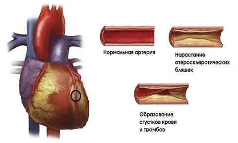 Ишемия атеросклероз