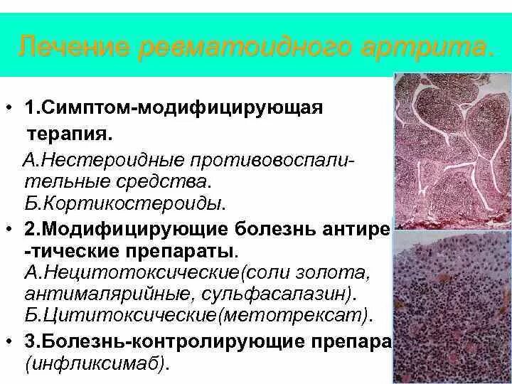 Терапия ревматических заболеваний. Терапия при ревматоидном артрите препараты. Симптоматическая терапия ревматоидного артрита. Лечениетревматоидного артрита. Можно ли при ревматоидном артрите принимать