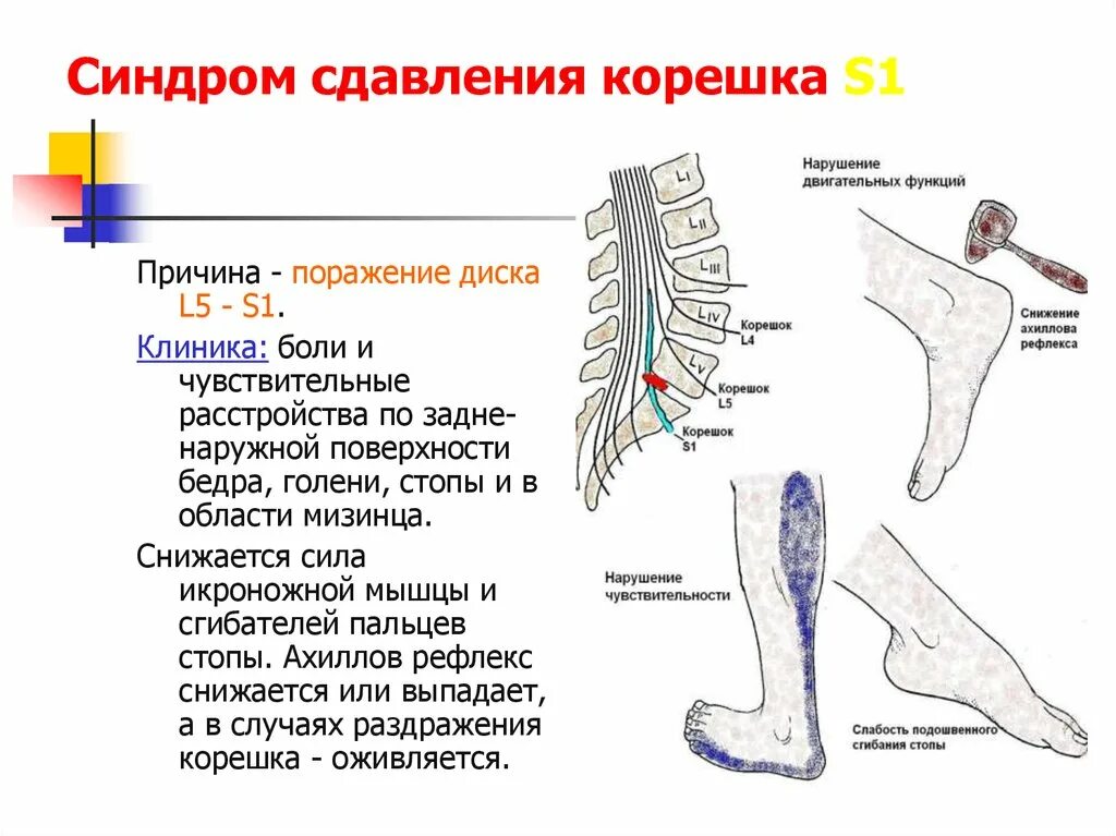 Корешковое поражение. Корешковый синдром l3. Компрессия s1 корешка симптомы. Корешковый синдром s1 симптомы. Поражение корешка л5.