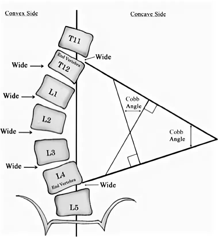 Метод Кобба. Методика измерения углов по коббу. Угол Кобба 14. Угол кобба