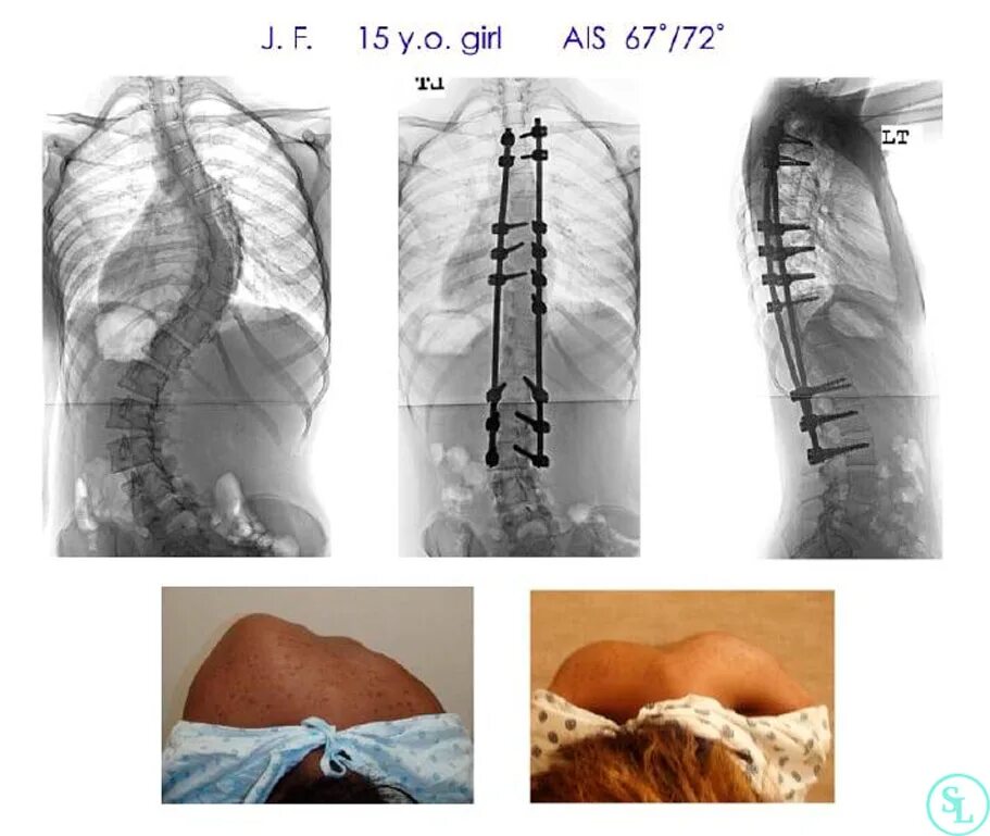 Сколиоз 4 степени операция. Транспедикулярная фиксация позвоночника сколиоз. Операция на сколиоз 2 степени.