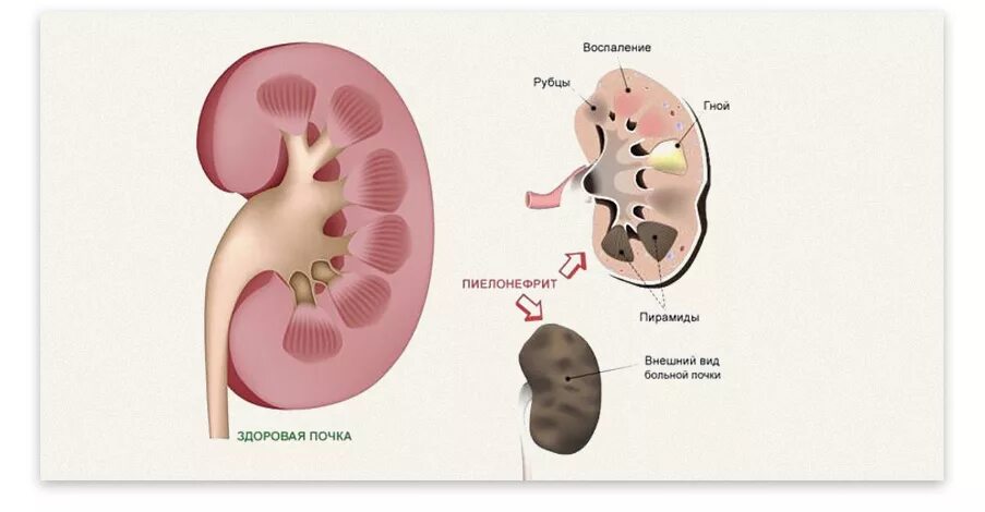 Пиелонефрит почки этиология. Хронический пиелонефрит вид почки. Хронический пиелонефрит строение почек. Односторонний хронический пиелонефрит. Пневмония пиелонефрит