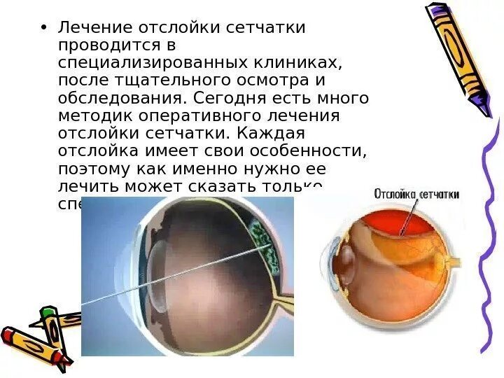 Можно восстановить сетчатку глаза