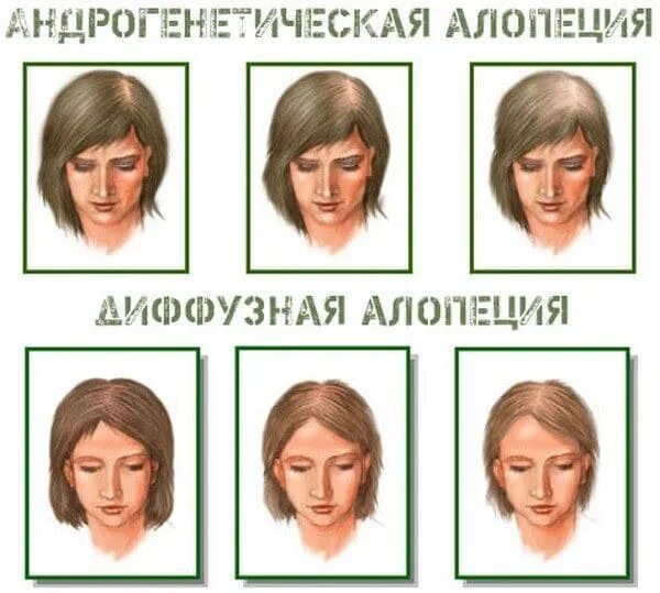 Типы облысения у женщин. Типы облысения. женский тип выпадения волос. андрогенная алопеция женский тип.