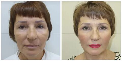 Малярный лифтинг