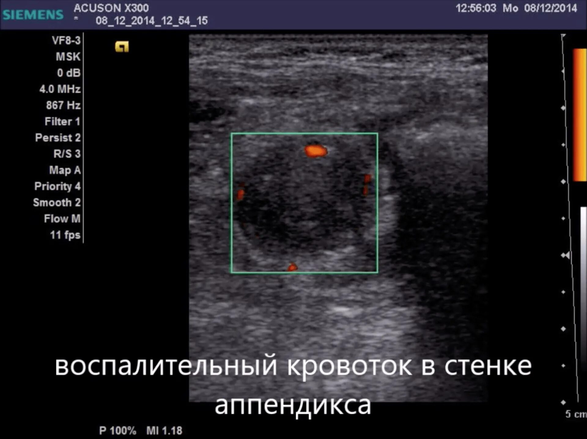Аппендицит на узи можно ли. Узи червеобразного отростка. норма червеобразного отростка на узи.