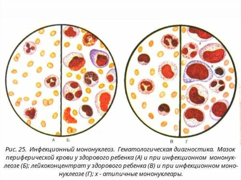 Атипичных мононуклеаров