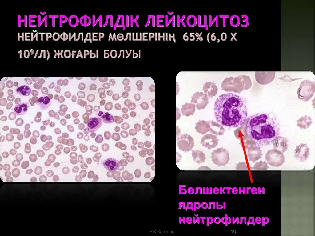 Лейкоцитоз жалобы. Умеренный лейкоцитоз. Лейкоцитоз микроскопия. Ложный лейкоцитоз. Абсолютный нейтрофильный лейкоцитоз.