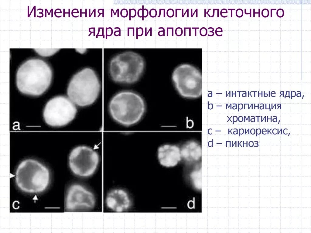 Кариопикноз это. Изменения ядра клетки. Изменение ядра при апоптозе. Патология ядра. Изменение структуры ядра при гибели клетки.