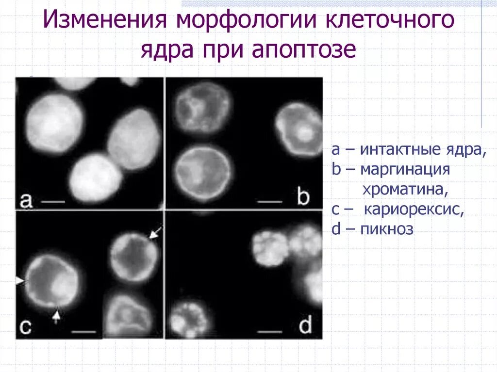 Необратимые изменения клетки. Изменения ядра клетки. изменение ядра при апоптозе. патология ядра. изменение структуры ядра при гибели клетки.