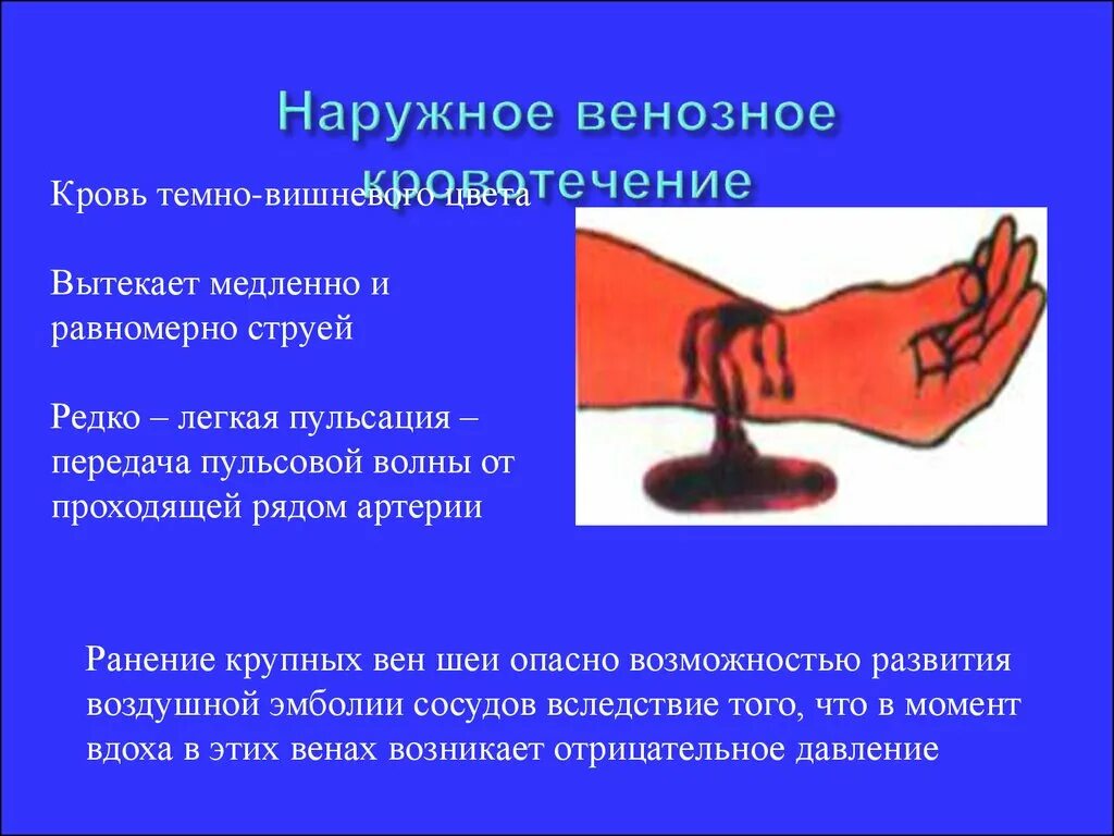 Пострадавшему с сильным наружным кровотечением. Остановка венозного кровотечения. Наружное венозное кровотечение. Венозная кровотеченте.