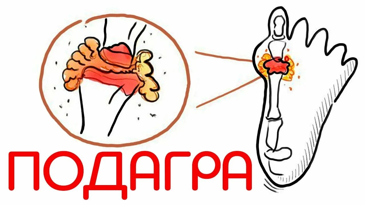Подагра болезнь королей. Почему болезнь королей