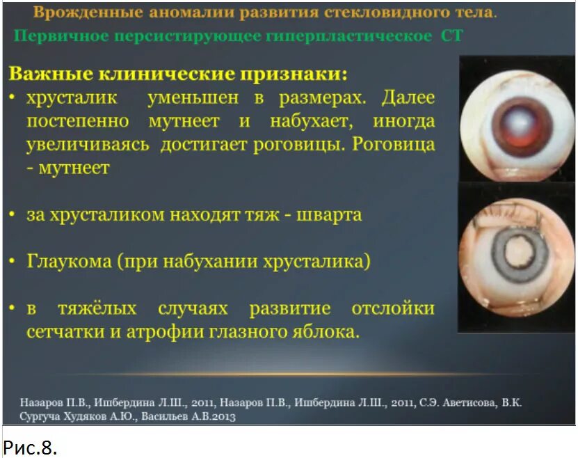 Врожденные аномалии развития. Аномалии развития стекловидного тела. Врожденные патологии развития. Аномалии аномалии развития хрусталика.