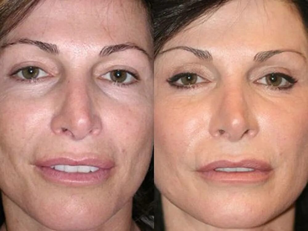 Плазмалифтинг лицо. Плазмолифтинг для лица. Плазмотерапия лица до и после. Плазмолифтинг до ми после.