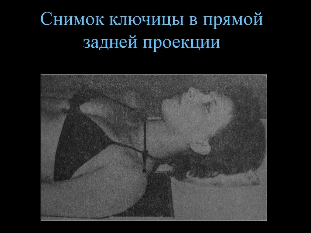 Снимок в прямой проекции. Снимок ключицы в аксиальной проекции. рентгенограмма ключицы в аксиальной проекции. ключица в аксиальной проекции. рентген ключицы в аксиальной проекции.