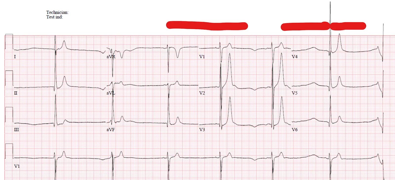 Феномен бругада на экг. Синусовая брадикардия на экг. Брадикардия сердца последствия. Брадикардия сердца последствия. Брадикардия на экг.