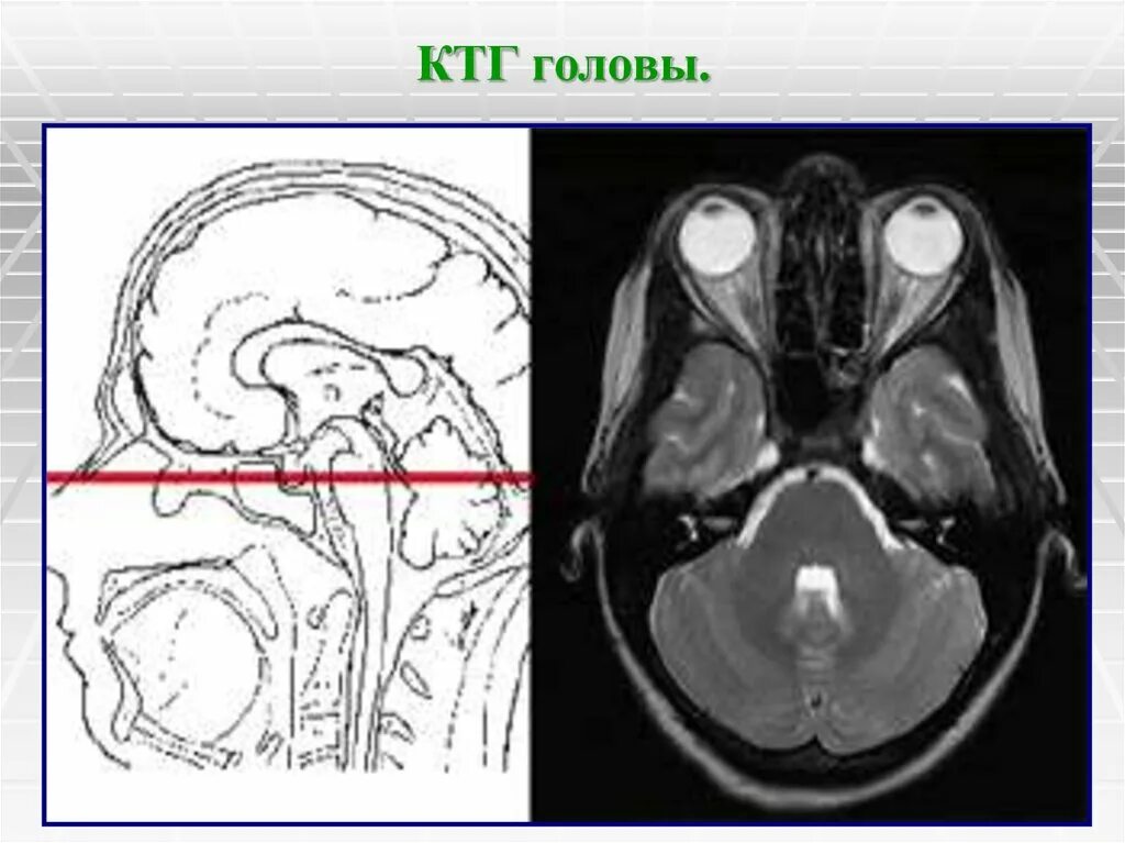 Хирургические заболевания головы. КТГ головного мозга ребенку. КТГ черепа. КТГ головы ребенка.