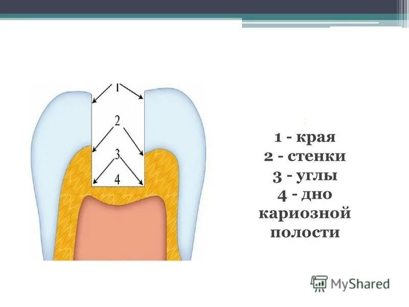 Способы препарирования кариозных полостей. Методы пломбирования кариозных полостей. Методика туннельного препарирования. Метод профилактического расширения по блэку. Ультразвуковой метод препарирования кариозных полостей.