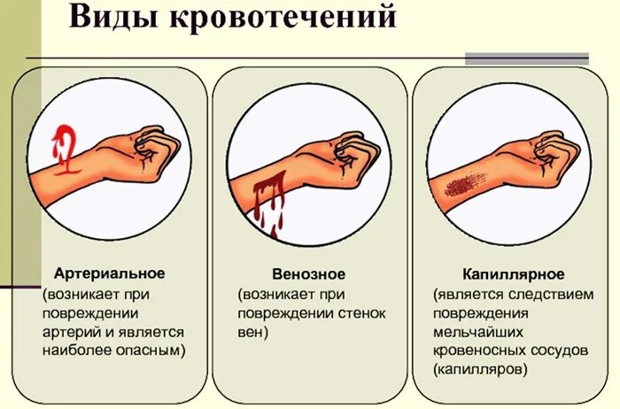 Артериальное кровотечение. Остановка артериального кровотечения алгоритм. Артериальное венозное и капиллярное кровотечение. Кровотечение остановить дома