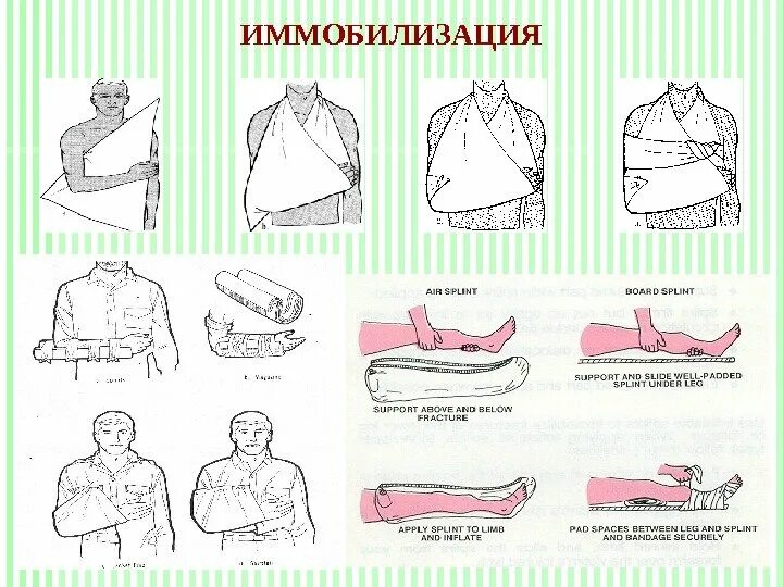 Как выполняется иммобилизация травмированной. Иммобилизация. иммобилизация конечности. иммобилизация при ожогах. иммобилизация при травмах конечностей.