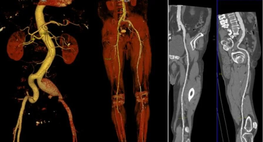 Кт флебография вен нижних конечностей. Кт ангиография брюшной аорты. Кт вен нижних конечностей с контрастированием. Кт ангиография сосудов нижних конечностей. Тромбоз вен таза