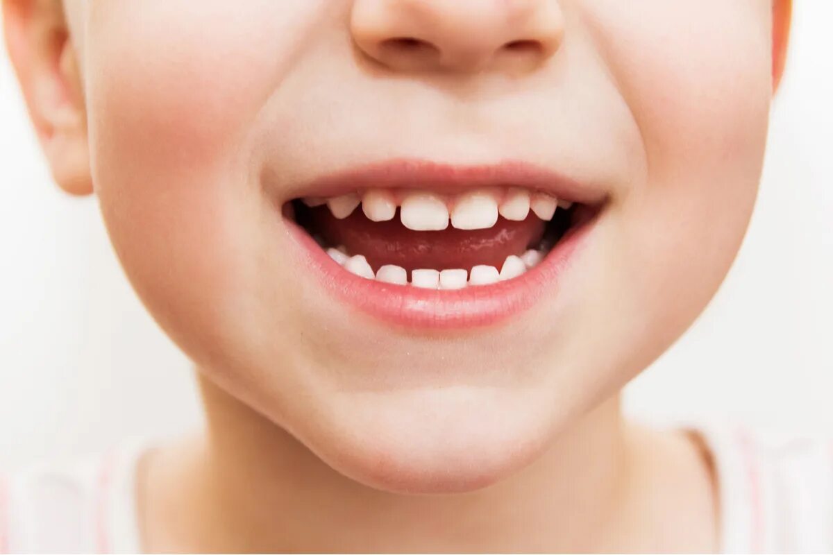 Pointed teeth