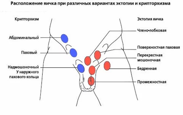 Лимфоузел в паху слева