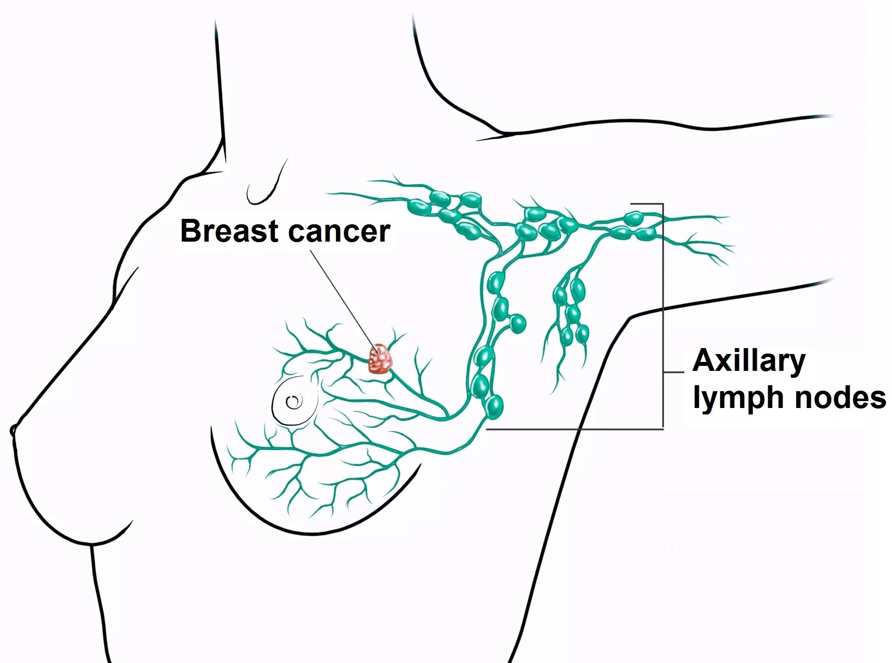 Аксиллярные лимфоузлы в молочной железе что это такое. Воспаление лимфатические узлы в грудной железе. Подмышечные лимфоузлы схема. Схема лимфоузлов под мышкой. Лимфоузлы при рмж