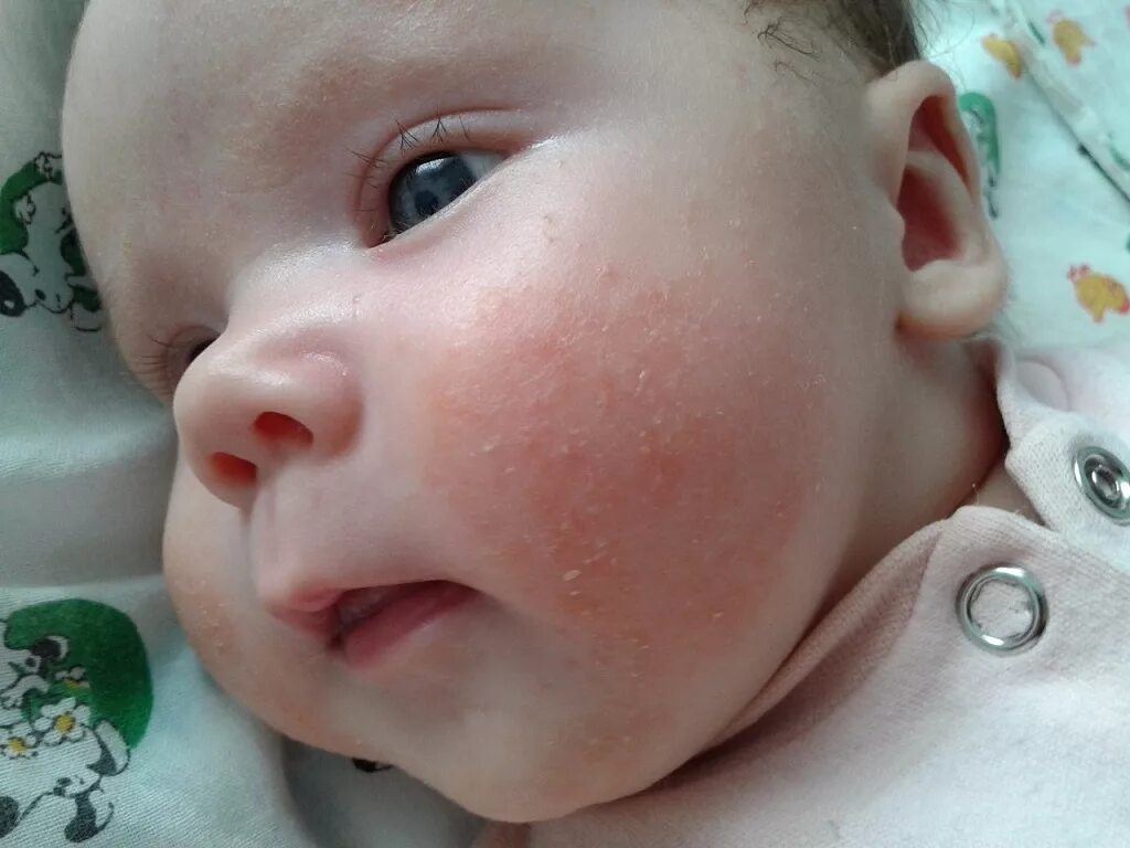 ребенку 3 месяца покраснение. неонатальный цефалический пустулез. цветение у грудничков фото. экссудативно катаральный диатез. потница на лице у грудничка.