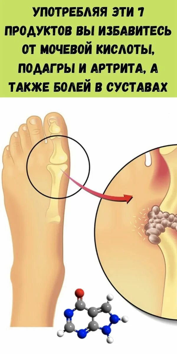 Против мочевой кислоты. Подагра и повышенная мочевая кислота. Мочевая кислота при подагре показатели. Падагра моечуая кислотв. Мочевая кислота в колене.