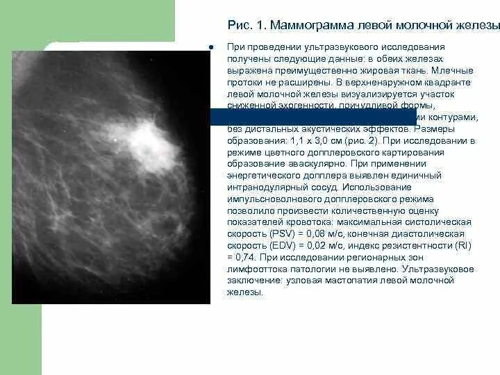 Фиброаденома молочной железы на маммографии описание. Узловая мастопатия маммограмма. Фиброзная мастопатия маммограмма. Фиброзно-кистозная мастопатия молочных желез на УЗИ. Категории маммографии