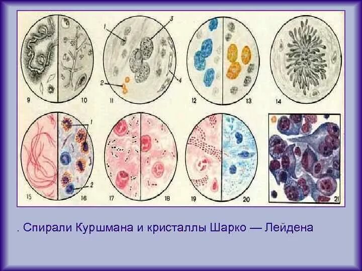 Микроскопия мокроты спирали Куршмана. Спирали Куршмана и Кристаллы Шарко-Лейдена. Исследование мокроты Кристаллы Шарко Лейдена. Исследование мокроты спирали Куршмана. Куршмана кристаллы шарко лейдена