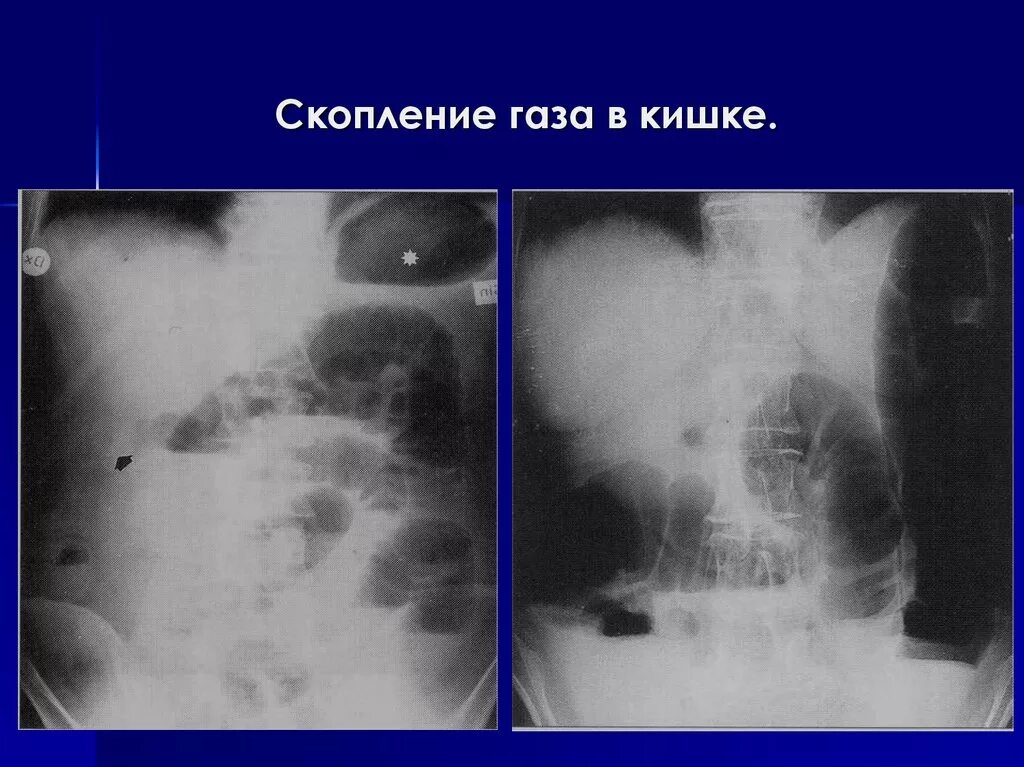 Почему повышенные газы. Скопление газов в кишечнике. Скапливаются ГАЗЫ В кишечнике. Скопление газов в кишечнике снимок. Газовый пузырь в кишечнике.