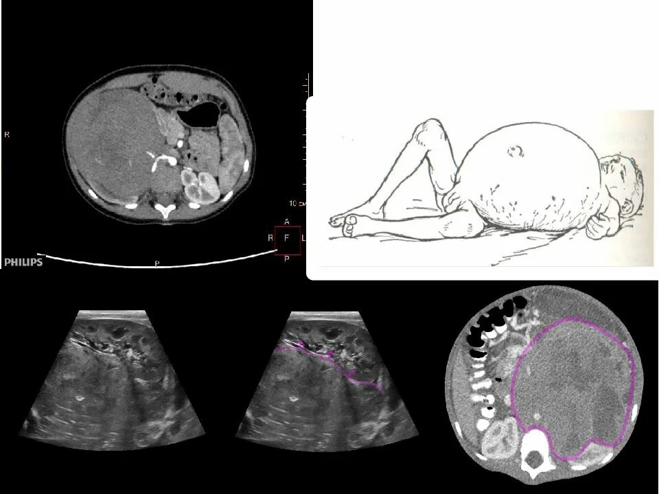 Нефробластома (опухоль Вильмса). Нефробластома почки кт. Эмбриональная нефробластома. Опухоль Вильсона нефробластома. Детские опухоли