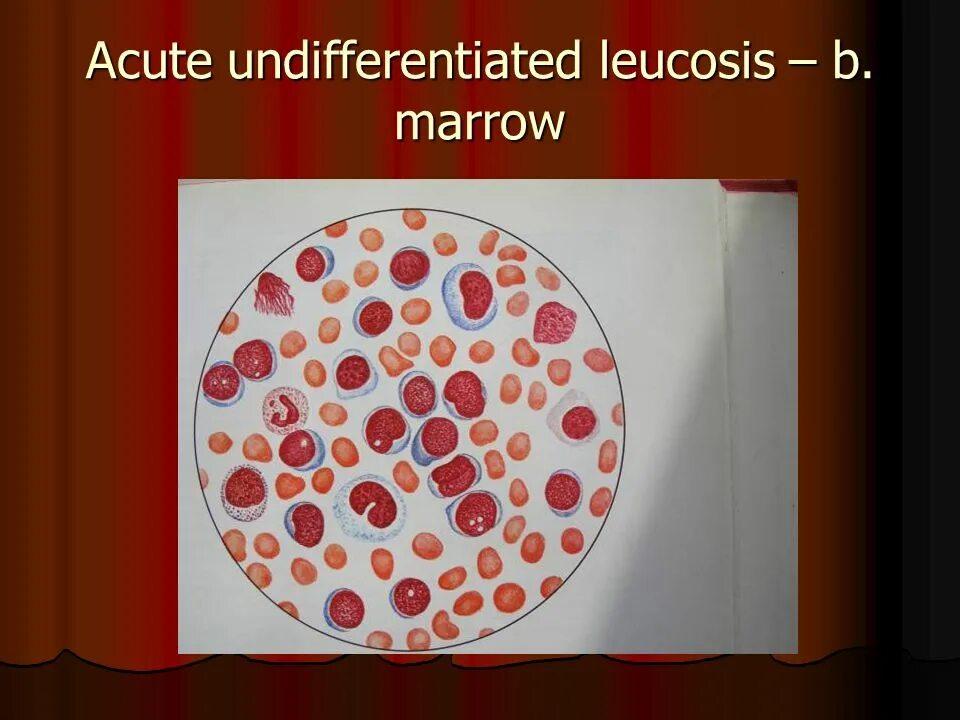 Мозг при остром лейкозе. Недифференцированный лейкоз. Недифференцируемый острый лейкоз. Недифференцированные острый недифференцированный лейкоз.