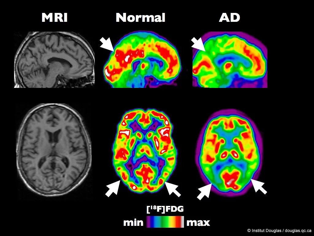 Позитронно-эмиссионная томография головного мозга. Позитронно-эмиссионная томография мозга (ПЭТ). ПЭТ кт при Альцгеймера. ПЭТ кт головного мозга.