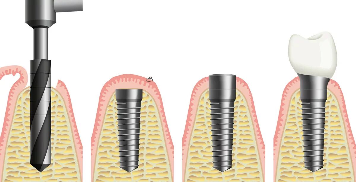 Устанавливают ли. Одномоментная имплантация зубов этапы. Inno импланты. Этапы имплантации зуба абатмент. Двухэтапная имплантация.