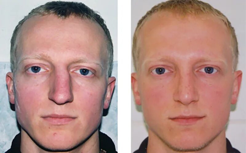 Ровная носовая перегородка. Искривление переносицы носа. Перелом носа исправление. Перелом носа исправление. Перелом носа исправление.