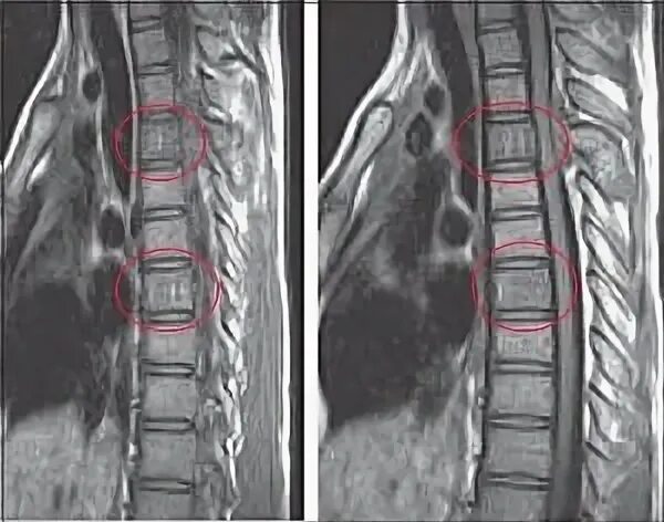 гемангиолипома позвонка l3. гемангиома th4 позвонка. гемангиома тела th4. гемангиома позвоночника с 7. гемангиома позвоночника l5.