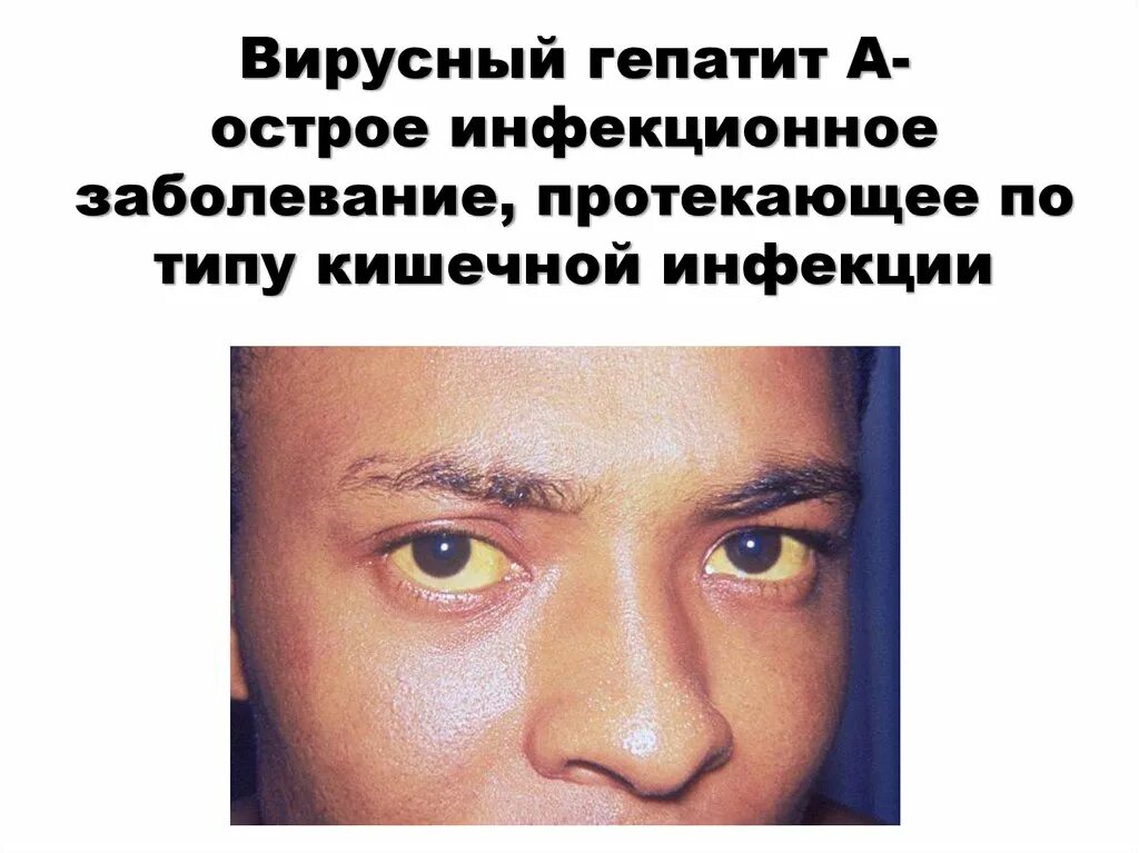 Гепатит болезнь грязных. Глаза больного гепатитом. вирусный гепатит с презентация инфекционные болезни.