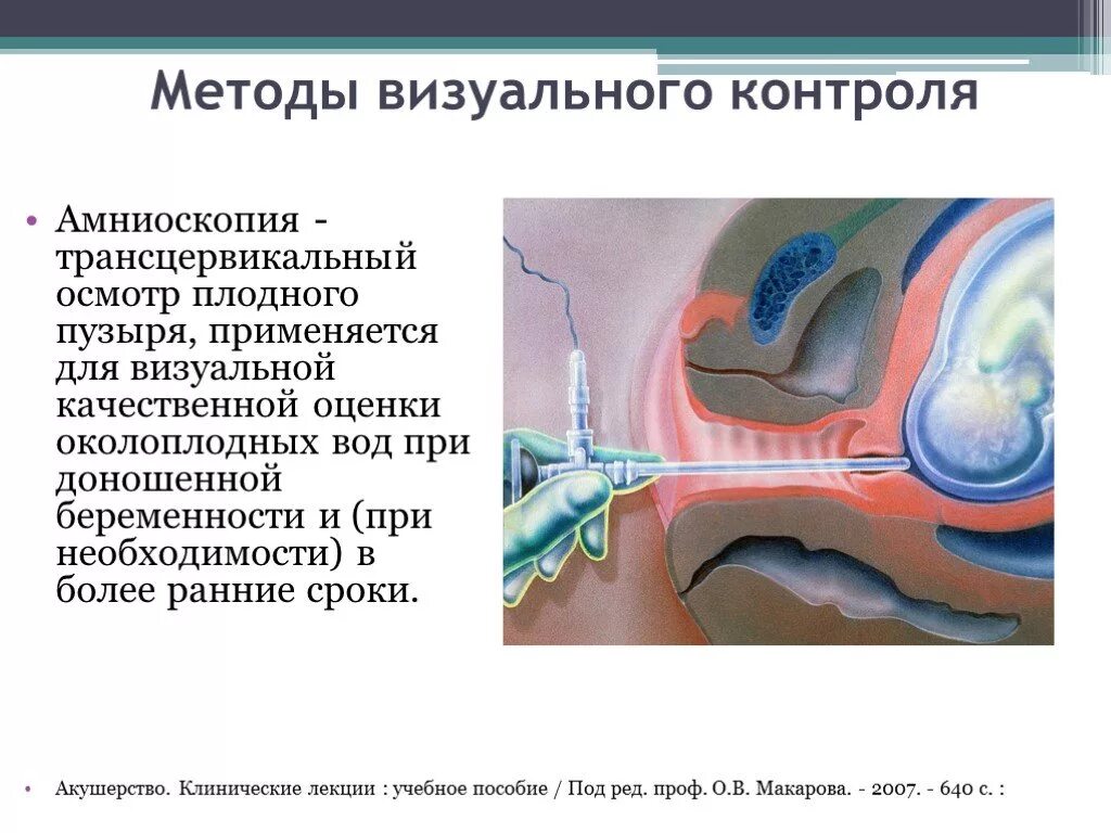 Амниоскопия околоплодных вод. Амниоскопия при беременности.