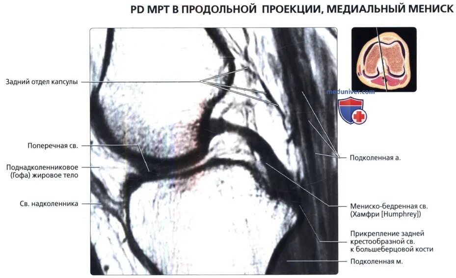 Мениско бедренная связка мрт. Анатомия менисков коленного сустава мрт. Мениско-бедренная связка мрт анатомия.