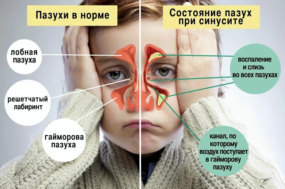 Гайморовы пазухи. Гайморовы пазухи гайморит. синусит верхнечелюстной пазухи. гайморит воспаление верхнечелюстной придаточной пазухи.