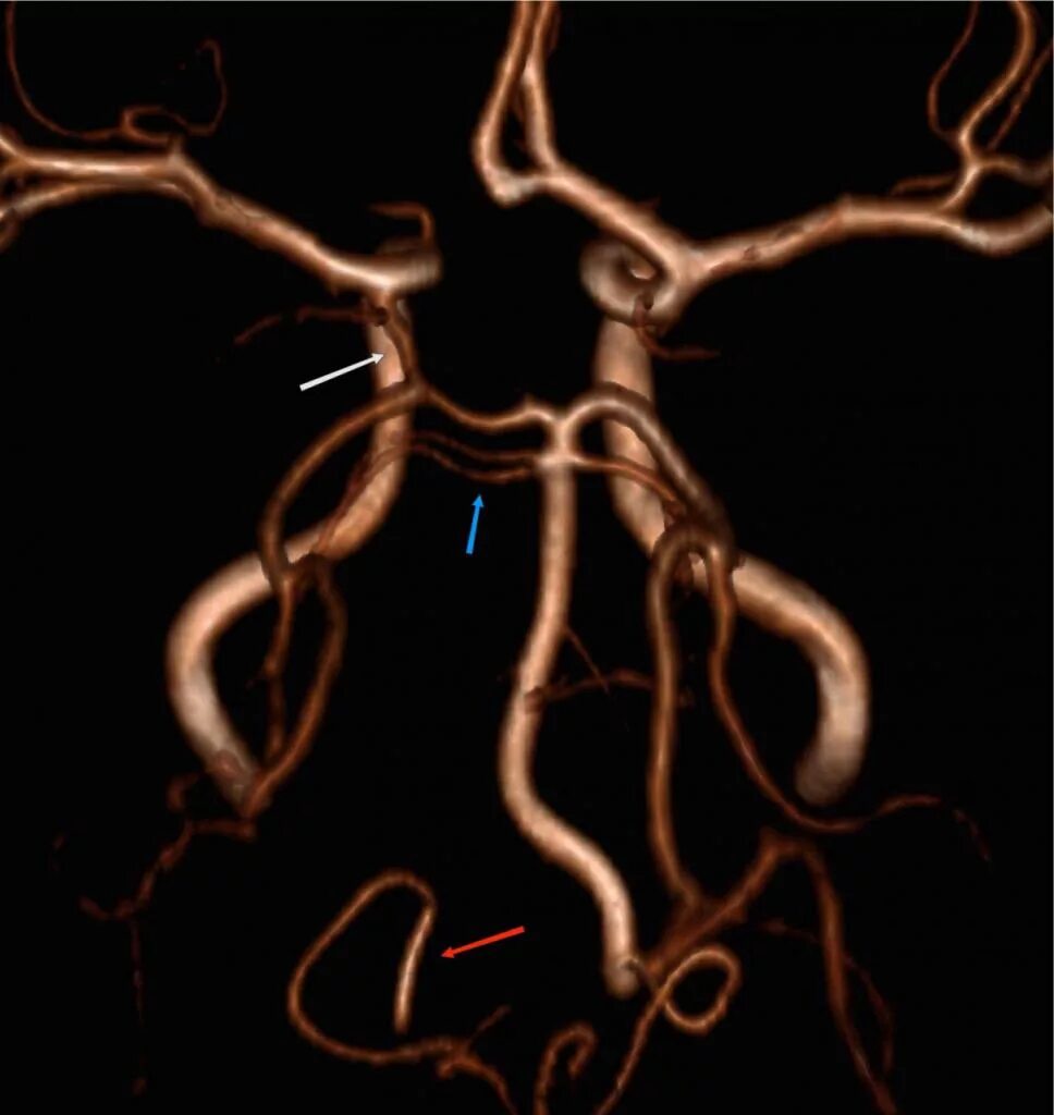 Гипоплазия позвоночной артерии кт. Гипоплазия правой позвоночной артерии сегменты. Гипоплазия а1 сегмента левой ПМА. Гипоплазия v4 позвоночной артерии. Гипоплазия правой артерии головного мозга