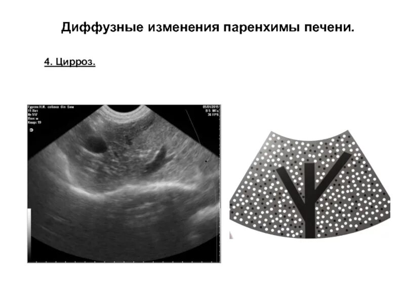 Признаки диффузных изменений паренхимы печени что это