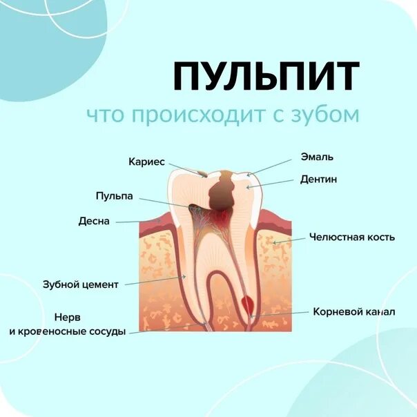 Пульпит карта