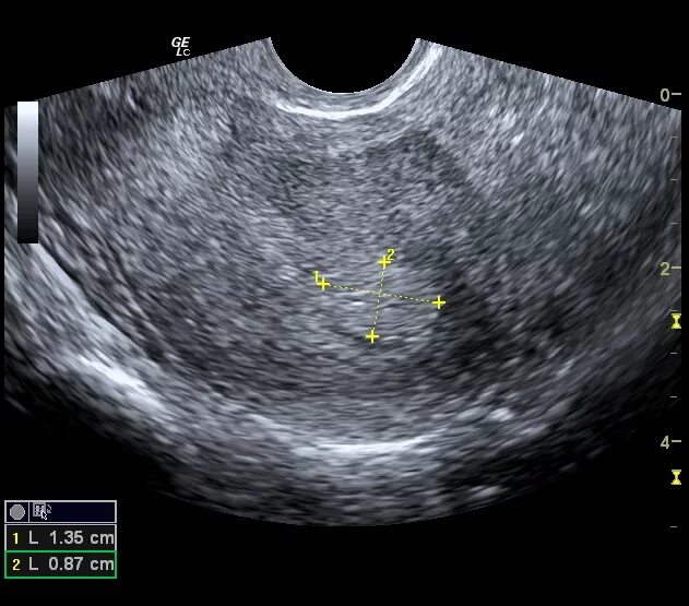 Дисплазия шейки матки на УЗИ. Некроз миоматозного узла на УЗИ. Матка 25 мм