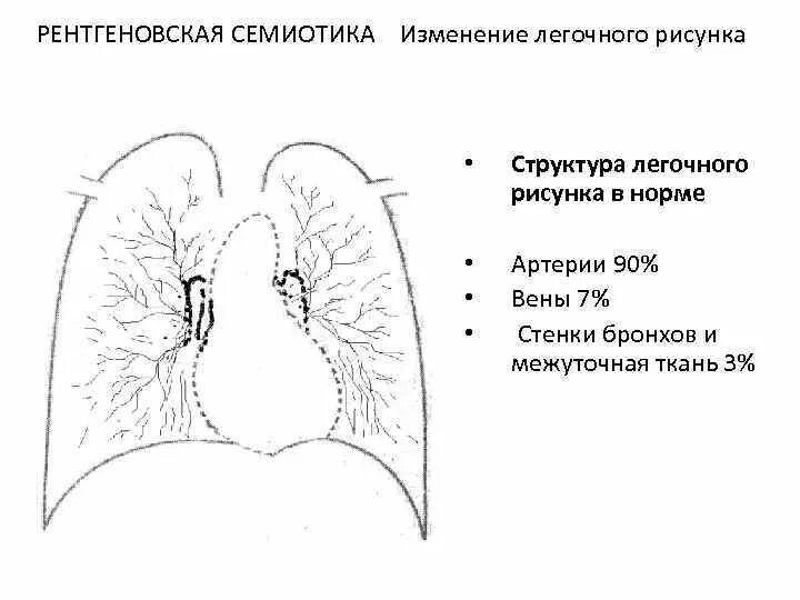 Усилен рисунок. Изменение легочного рисунка. Патологические изменения легочного рисунка. Структуры легочного рисунка. Легочный рисунок в норме.