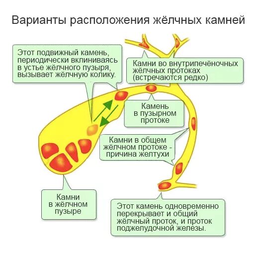 Могут ли выйти камни из желчного пузыря. Локализация желчных камней. Схема образования камней в желчном пузыре. Локализация камней при желчнокаменной болезни. Желчекаменная болезнь патогенез схема.