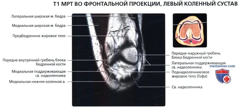 Мрт коленного сустава аксиальная проекция. Поднадколенниковое жировое тело. Мрт коленного сустава норма.